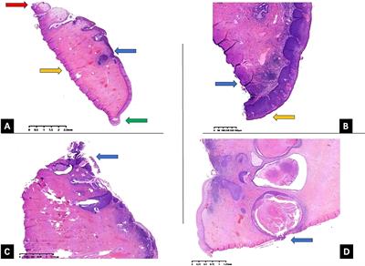 Risk factors of LEEP margin positivity and optimal length of cervical conization in cervical intraepithelial neoplasia